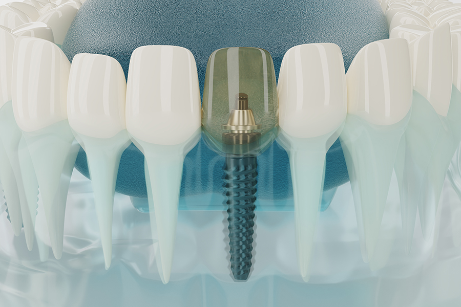 Implantes dentales en Jaén
